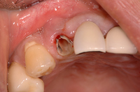 インプラント前歯